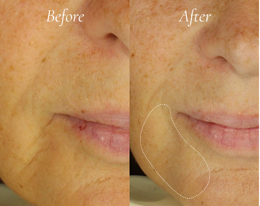 Before and after comparison