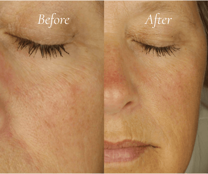 Anti-aging skin treatment before and after
