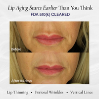 Before and after 84 days of at-home lip wrinkle treatment showing reduced perioral lines and vertical smoker lines treatment no filler results before-after 