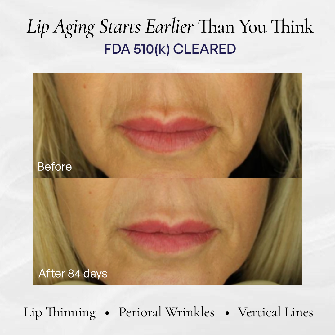 Before and after 84 days of at-home lip wrinkle treatment showing reduced perioral lines and vertical smoker lines treatment no filler results