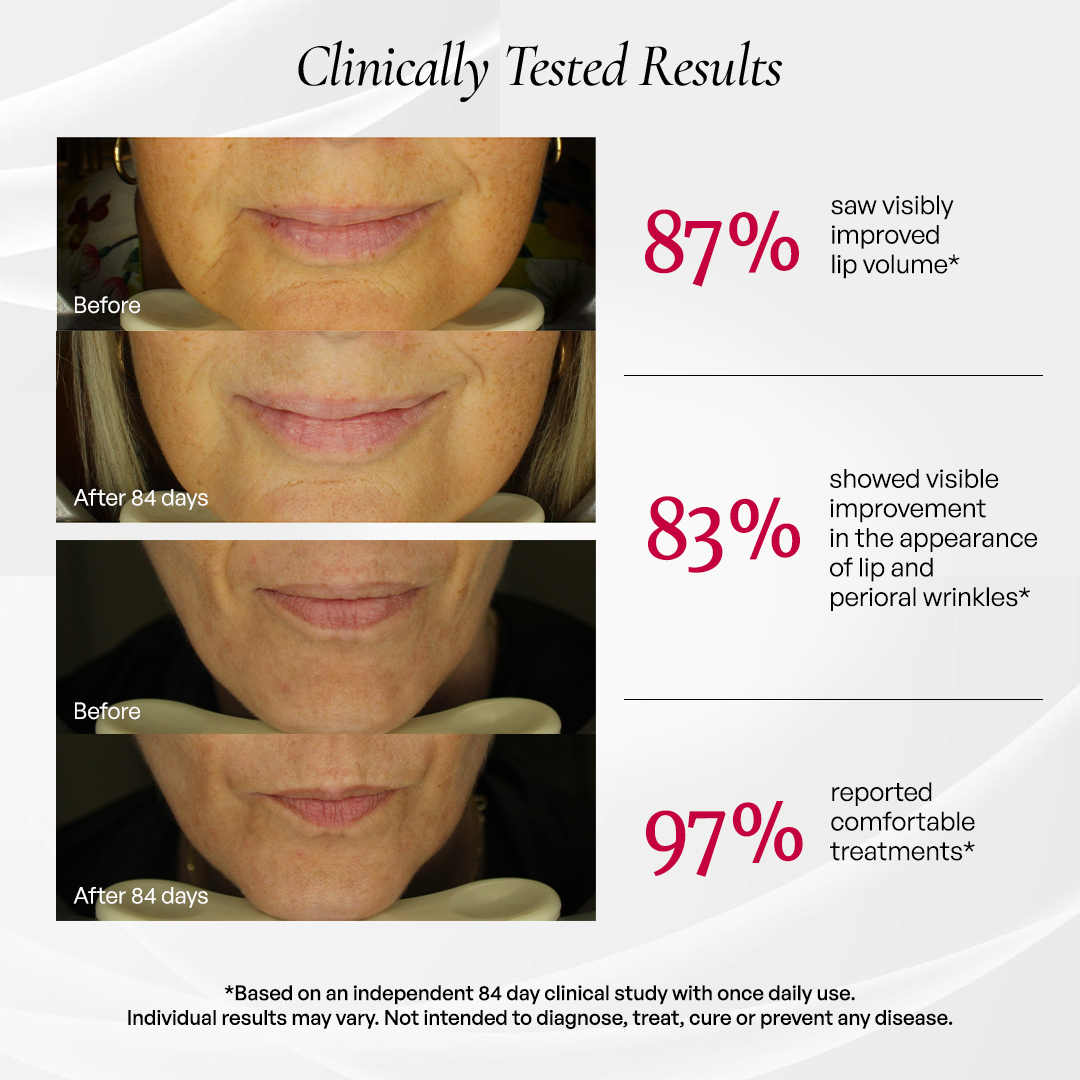Clinically tested results - at-home lip wrinkle treatment showing 87% improved lip volume and 83% reduction in perioral lines device study
