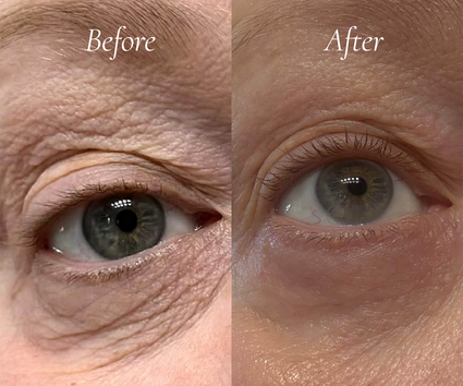 Metamorphosis Before and after comparison of an eye with visible aging signs.