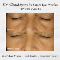 Before and after comparison of under-eye wrinkle reduction after 84 days using an FDA-cleared treatment system. before-after 