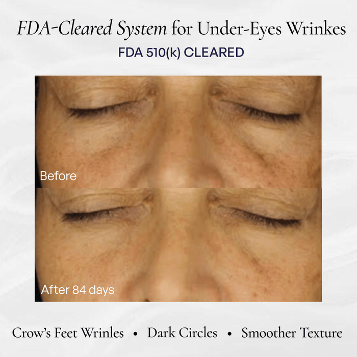 Before and after comparison of under-eye wrinkle reduction after 84 days using an FDA-cleared treatment system. before-after 
