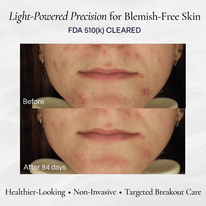 before-after Before and after comparison showing the results of light therapy on acne over 84 days, featuring the text "Light-Powered Precision for Blemish-Free Skin" and "FDA 510(k) CLEARED 
