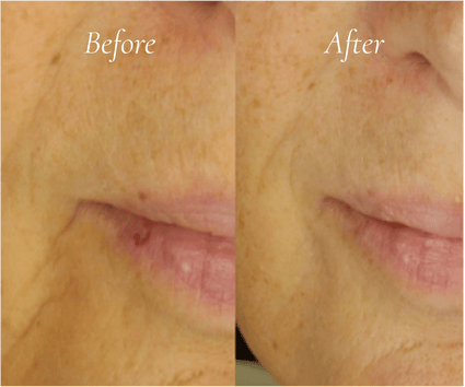 Metamorphosis lip treatment