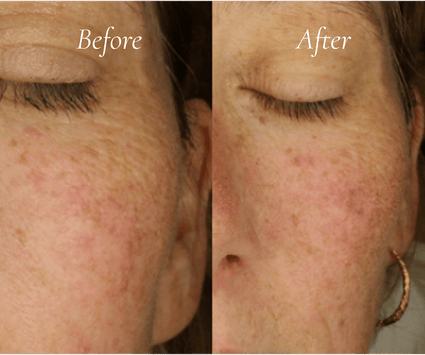Metamorphosis skin treatment results